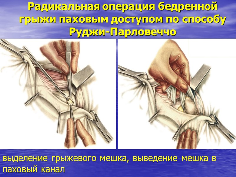 Радикальная операция бедренной грыжи паховым доступом по способу Руджи-Парловеччо выделение грыжевого мешка, выведение мешка